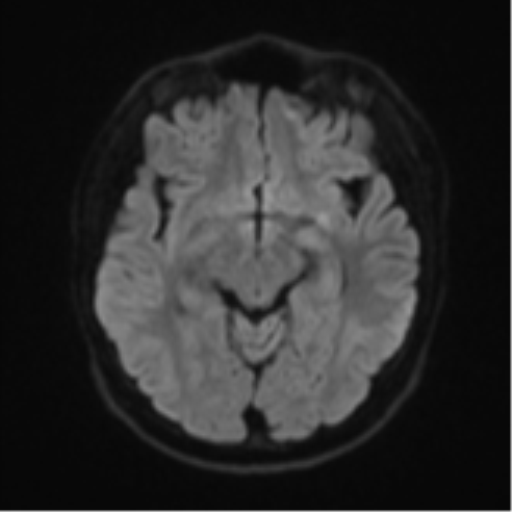 Acute left middle cerebral artery territory infarct with clot retrieval (Radiopaedia 47732-52433 Axial DWI 43).png