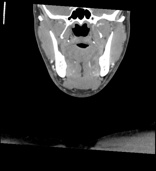 Acute longus colli calcific tendinitis (Radiopaedia 72495-83036 Coronal C+ arterial phase 13).jpg