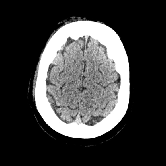 Acute middle cerebral artery territory infarct (Radiopaedia 52380-58283 Axial non-contrast 89).jpg
