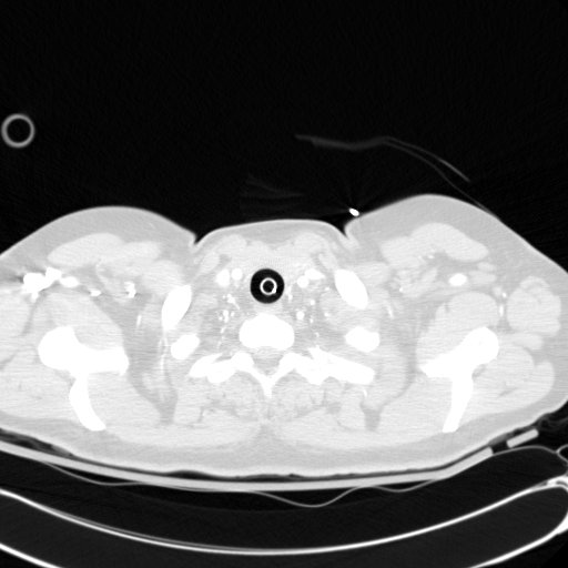 Acute myocardial infarction in CT (Radiopaedia 39947-42415 Axial lung window 2).jpg