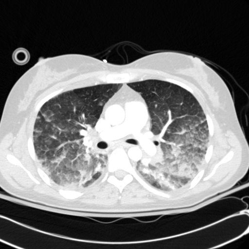 Acute myocardial infarction in CT (Radiopaedia 39947-42415 Axial lung window 54).jpg