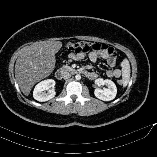 File:Acute on chronic pancreatitis (Radiopaedia 80902-94423 Axial C+ portal venous phase 76).jpg