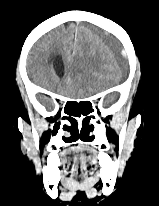 Acute on chronic subdural hematoma (Radiopaedia 74814-85823 Coronal non-contrast 23).jpg