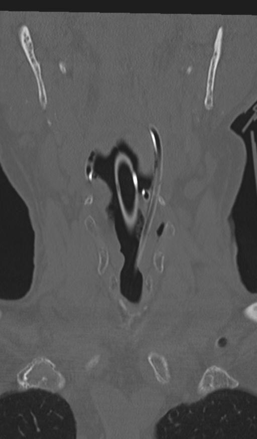Acute on chronic subdural hematoma and thoracic vertebral injury in a multitrauma patient (Radiopaedia 31698-32619 Coronal bone window 4).jpg