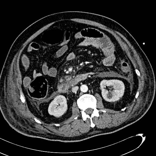 File:Acute pancreatic necrosis (Radiopaedia 13560-13486 Axial C+ portal venous phase 75).jpg