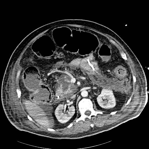 File:Acute pancreatic necrosis (Radiopaedia 13560-18502 Axial C+ portal venous phase 33).jpg