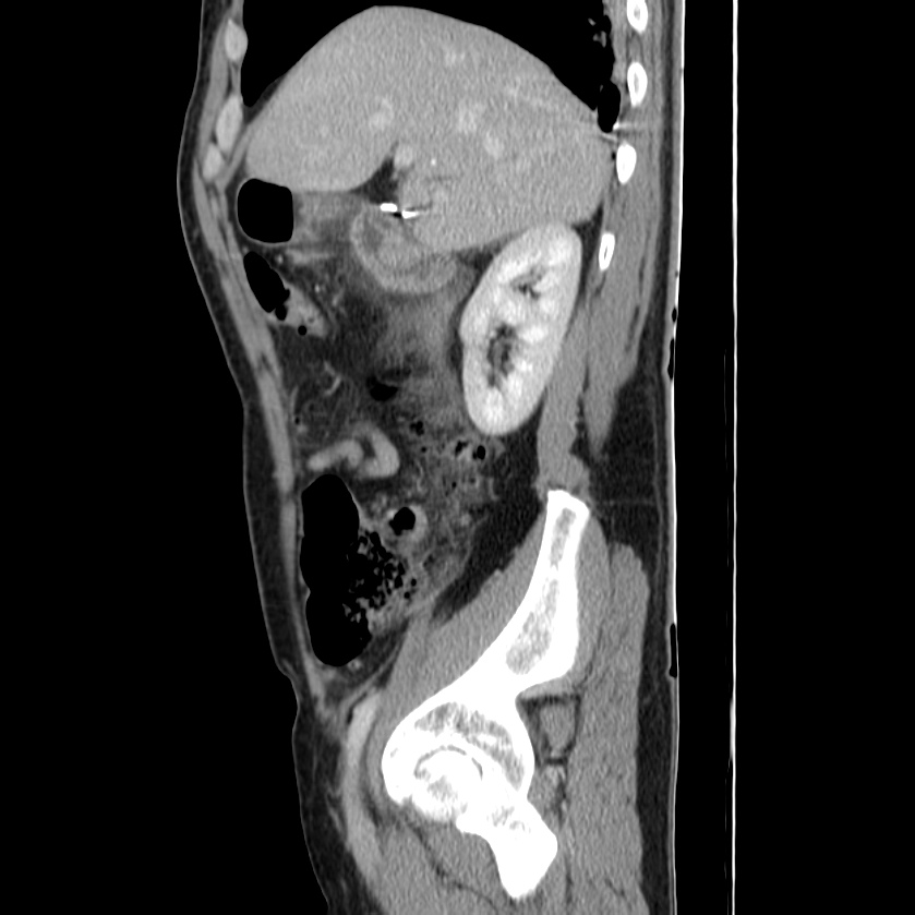 Acute pancreatitis (Radiopaedia 22572-22596 Sagittal C+ portal venous phase 16).jpg