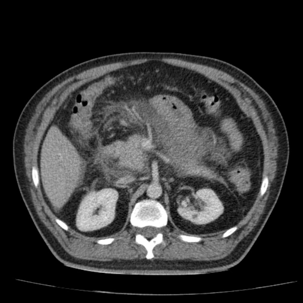 Acute pancreatitis (Radiopaedia 26663-26813 Axial C+ portal venous phase 30).jpg