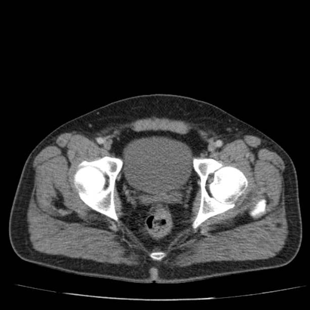 Acute pancreatitis (Radiopaedia 26663-26813 Axial C+ portal venous phase 82).jpg