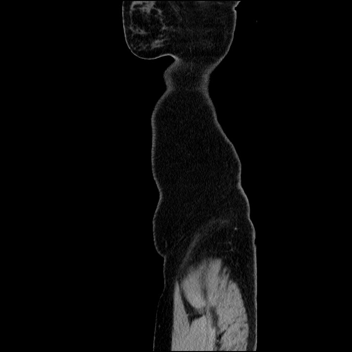 Acute pancreatitis (Radiopaedia 69236-79012 Sagittal C+ portal venous phase 11).jpg