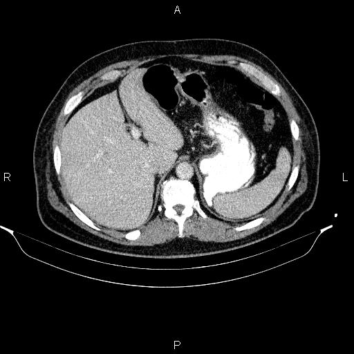 File:Acute pancreatitis (Radiopaedia 85390-101010 Axial C+ portal venous phase 22).jpg