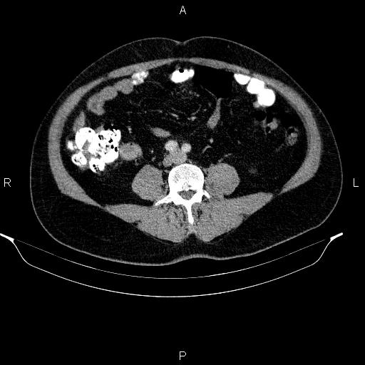 Acute pancreatitis (Radiopaedia 85390-101010 Axial C+ portal venous phase 67).jpg