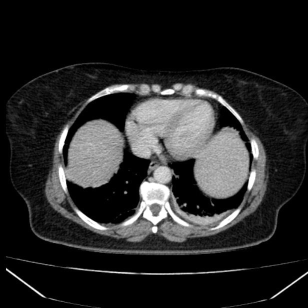 Acute pancreatitis - Balthazar C (Radiopaedia 26569-26714 Axial C+ portal venous phase 16).jpg
