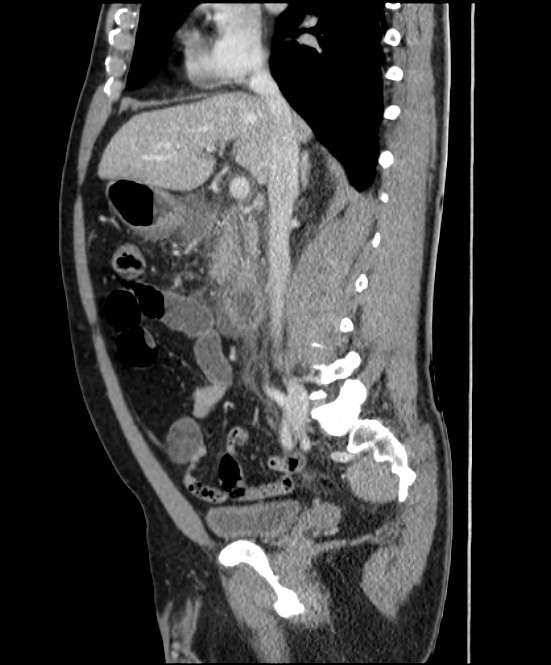 Acute pancreatitis - Balthazar E (Radiopaedia 23080-23110 Sagittal C+ portal venous phase 40).jpg