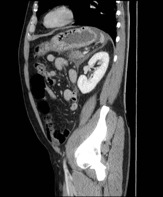 Acute pancreatitis - Balthazar E (Radiopaedia 23080-23110 Sagittal C+ portal venous phase 72).jpg
