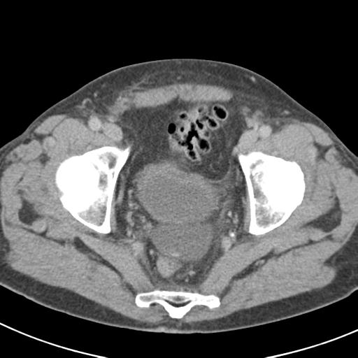 Acute pancreatitis and walled-off necrosis (Radiopaedia 29888-30403 Axial C+ delayed 76).jpg