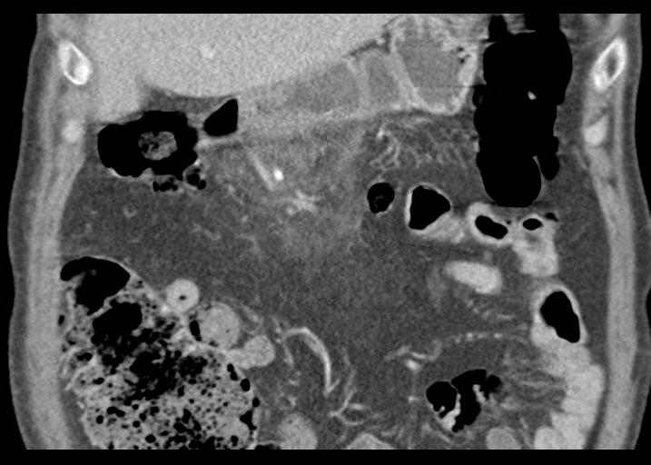File:Acute pancreatitis and walled-off necrosis (Radiopaedia 29888-30403 Coronal C+ portal venous phase 19).jpg