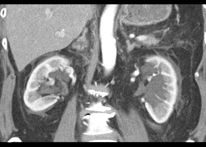 Acute pancreatitis and walled-off necrosis (Radiopaedia 29888-30403 Coronal C+ portal venous phase 35).jpg