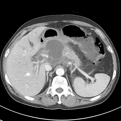 File:Acute pancreatitis and walled-off necrosis (Radiopaedia 29888-30404 Axial C+ portal venous phase 21).jpg