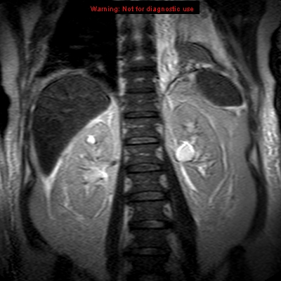 File:Acute pancreatitis with incidental pancreatic lipoma (Radiopaedia 10190-10732 Coronal T2 24).jpg