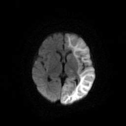 File:Acute phase of hemiconvulsion-hemiplegia epilepsy syndrome (Radiopaedia 29309-29745 Axial DWI 13).jpg