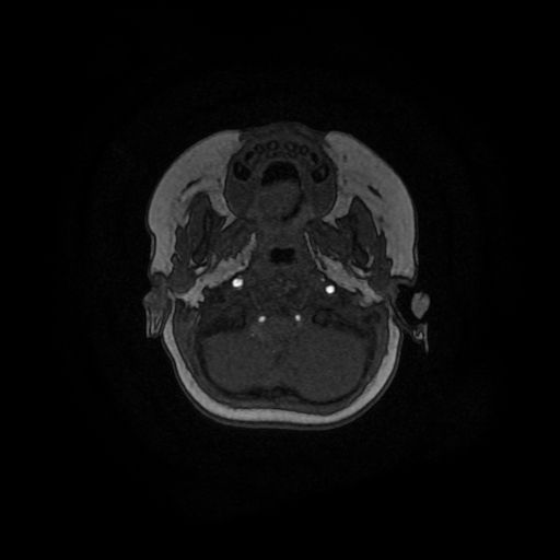 File:Acute phase of hemiconvulsion-hemiplegia epilepsy syndrome (Radiopaedia 29309-29745 Axial TOF angiography 147).jpg