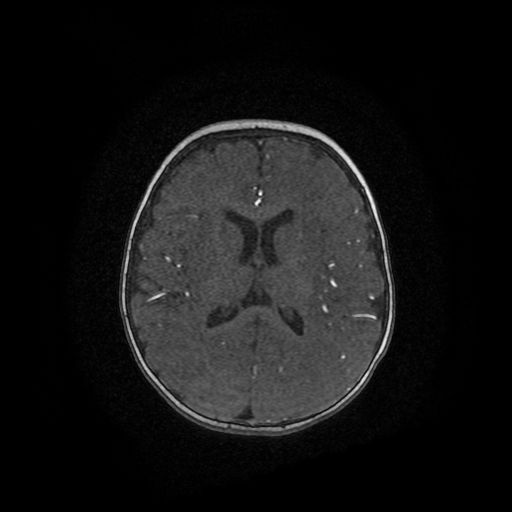 Acute phase of hemiconvulsion-hemiplegia epilepsy syndrome (Radiopaedia 29309-29745 Axial TOF angiography 35).jpg