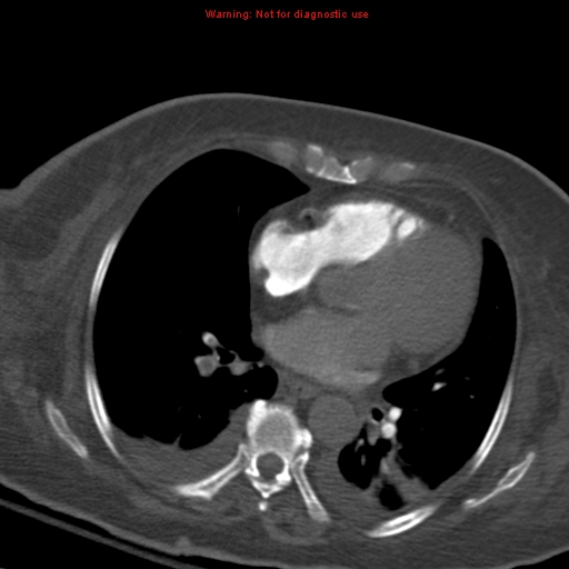 Acute pulmonary embolism (Radiopaedia 13286-13289 Axial C+ CTPA 39).jpg