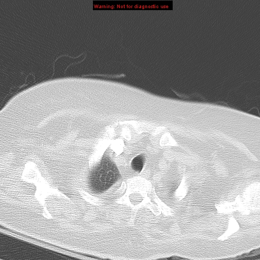 File:Acute pulmonary embolism (Radiopaedia 13286-13289 B 6).jpg