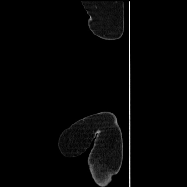 Acute pyelonephritis (Radiopaedia 25657-25837 Sagittal renal parenchymal phase 3).jpg