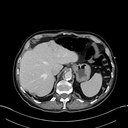 Acute renal infarction (Radiopaedia 59375-66736 Axial C+ portal venous phase 17).jpg