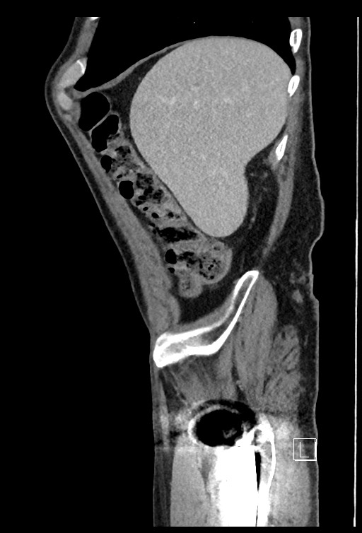 Acute renal infarction - rim capsular enhancement (Radiopaedia 59833-67270 Sagittal C+ portal venous phase 75).jpg
