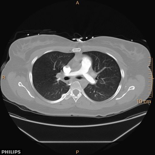 File:Acute reversible pulmonary hypertension and right heart failure from cocaine toxicity (Radiopaedia 49394-54517 Axial 7).jpg