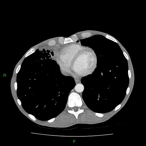 File:Acute right lung abscess (Radiopaedia 34806-36258 Axial C+ arterial phase 136).jpg
