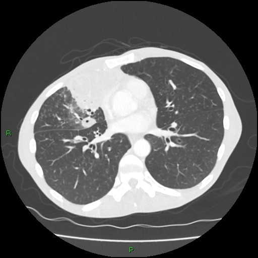 Acute right lung abscess (Radiopaedia 34806-36258 Axial lung window 111).jpg