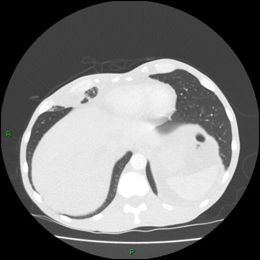 Acute right lung abscess (Radiopaedia 34806-36258 Axial lung window 159).jpg