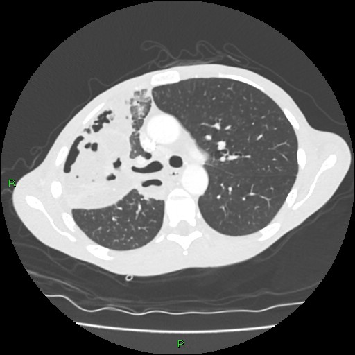 Acute right lung abscess (Radiopaedia 34806-36258 Axial lung window 70).jpg