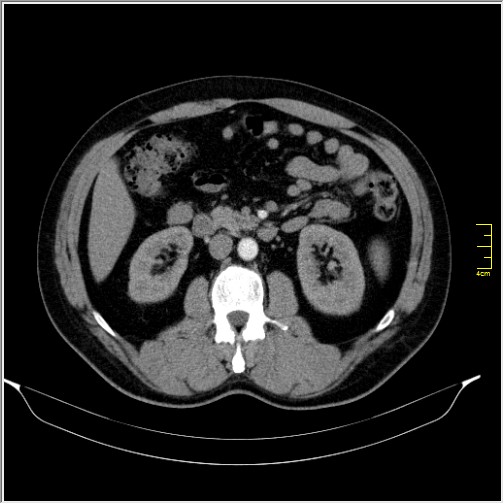 File:Acute right sided diverticulitis (Radiopaedia 65249-74268 Axial C+ portal venous phase 33).JPG
