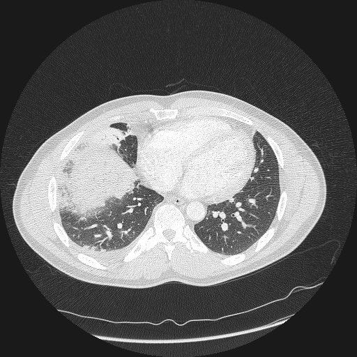 File:Acute segmental pulmonary emboli and pulmonary infarction (Radiopaedia 62264-70444 Axial lung window 130).jpg