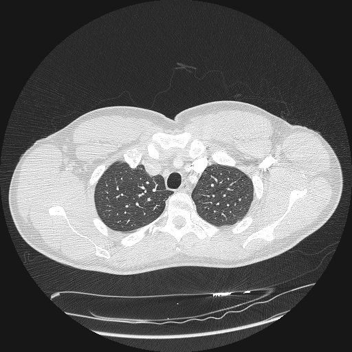Acute segmental pulmonary emboli and pulmonary infarction (Radiopaedia 62264-70444 Axial lung window 32).jpg