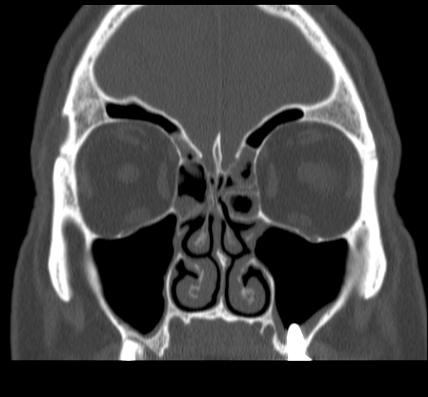 File:Acute sinusitis (Radiopaedia 23161-23215 Coronal bone window 32).jpg
