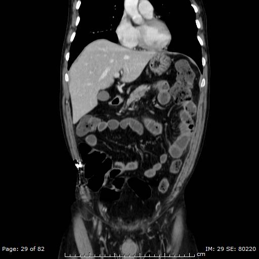 Acute superior mesenteric artery occlusion (Radiopaedia 43636-47060 Coronal C+ portal venous phase 14).jpg