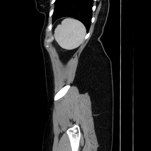 Acute uncomplicated appendicitis (Radiopaedia 73704-84499 Sagittal C+ portal venous phase 170).jpg
