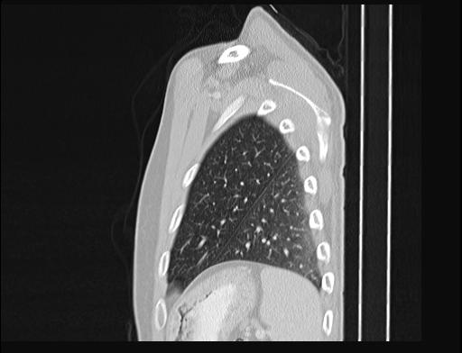 Addison disease (Radiopaedia 49318-54412 Sagittal lung window 9).jpg