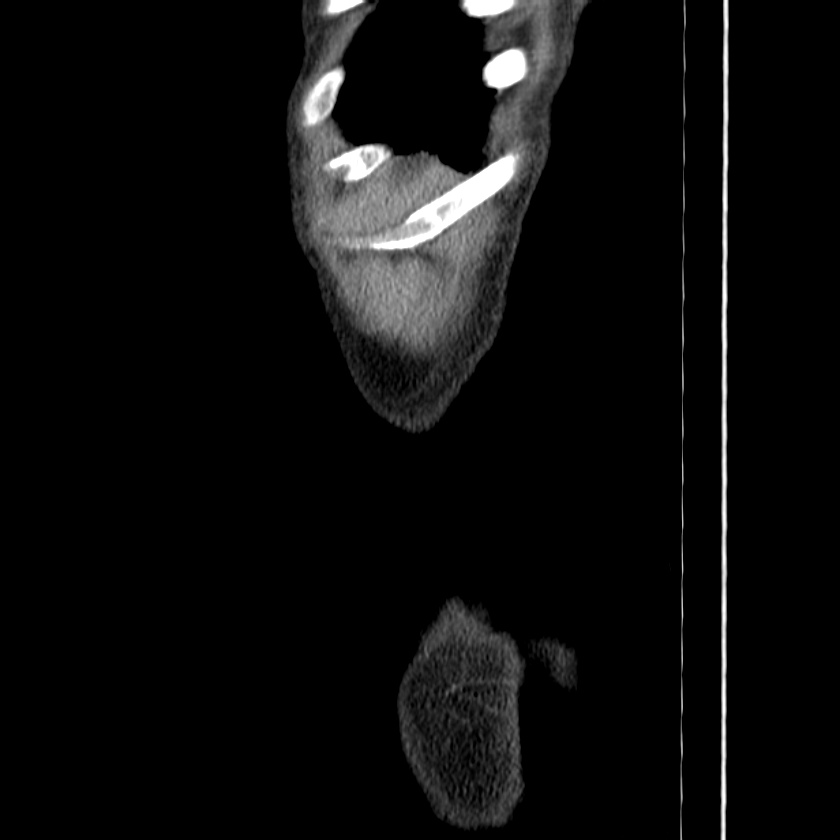 Adenocarcinoma of colon with entero-colic fistula (Radiopaedia 22832-22852 Sagittal C+ portal venous phase 65).jpg