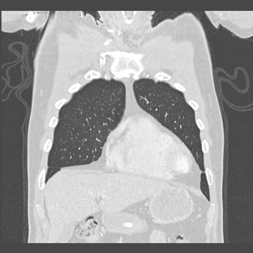 Adenocarcinoma of the lung (Radiopaedia 59871-67325 Coronal lung window 8).jpg
