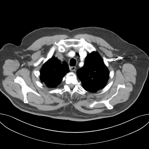 Adenocarcioma of rectum- T1 lesion (Radiopaedia 36921-38547 Axial C+ arterial phase 13).png