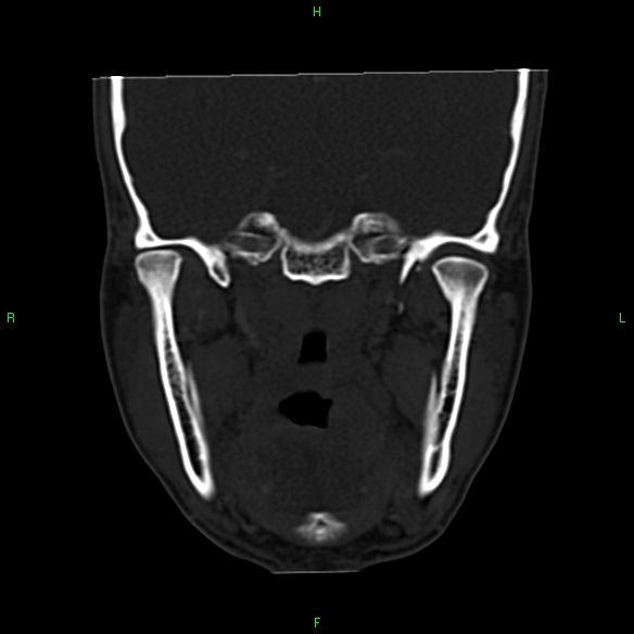 File:Adenoid cystic carcinoma of hard palate (Radiopaedia 26137-26273 Coronal bone window 20).jpg