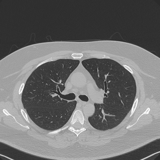 Adenoid cystic carcinoma of the trachea (Radiopaedia 49042-54137 Axial lung window 131).jpg