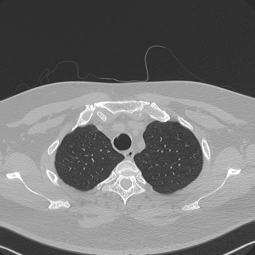 Adenoid cystic carcinoma of the trachea (Radiopaedia 49042-54137 Axial lung window 62).jpg